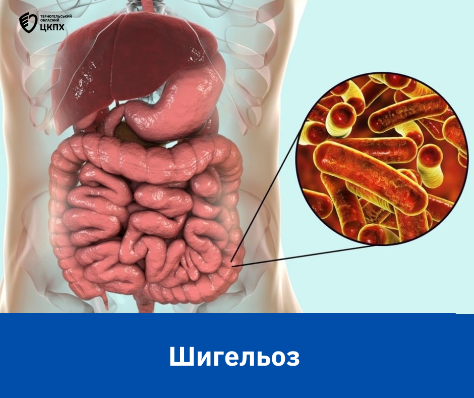 🦠 ШИГЕЛЬОЗ - причини, симптоми, профілактика