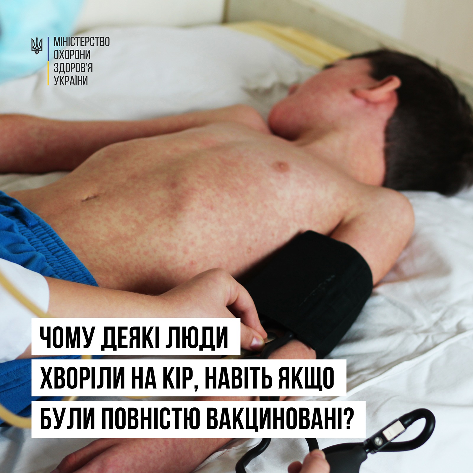 👨‍⚕ Чому деякі люди хворіють на кір, навіть якщо були повністю вакциновані?