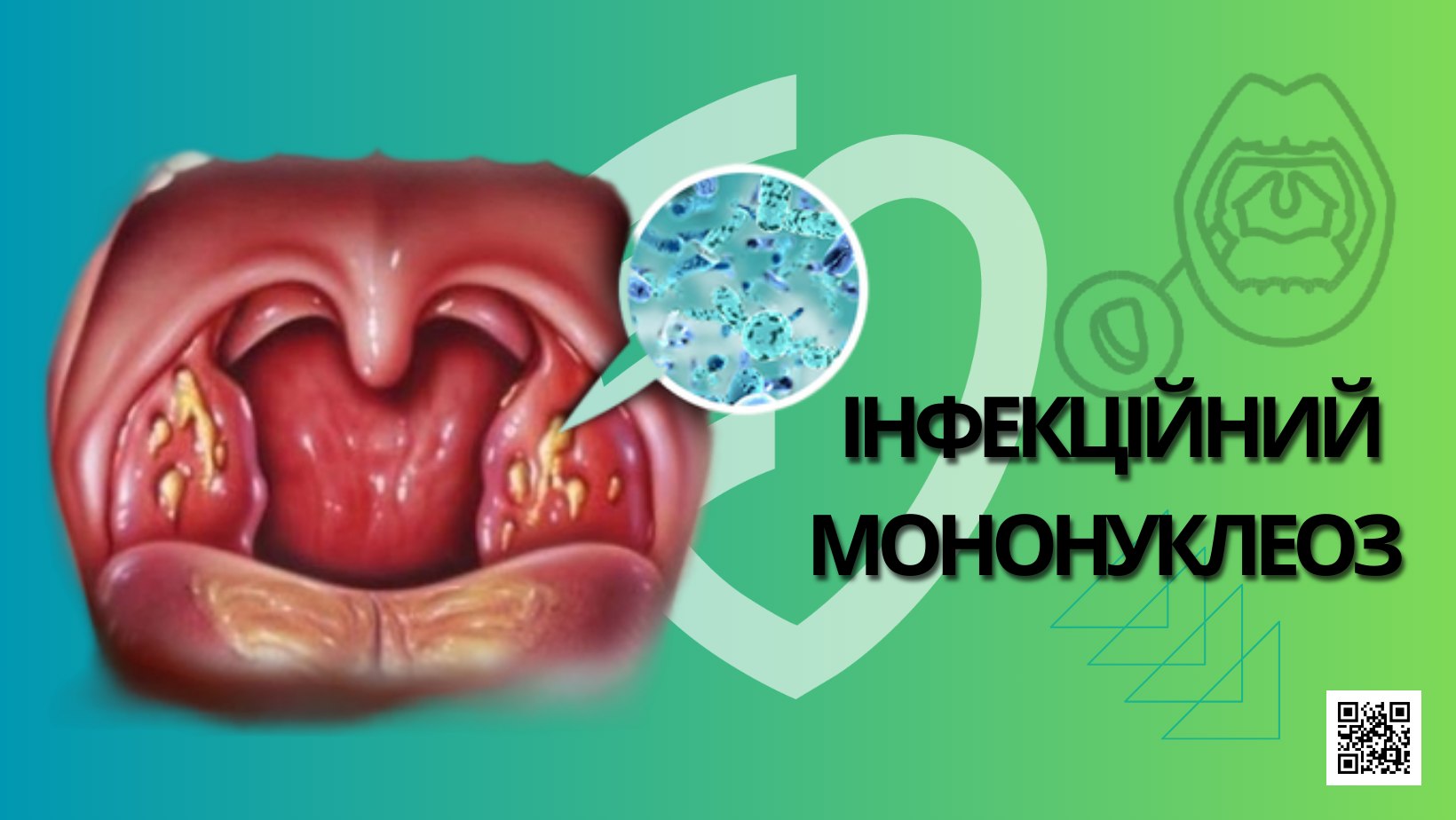 ІНФЕКЦІЙНИЙ МОНОНУКЛЕОЗ