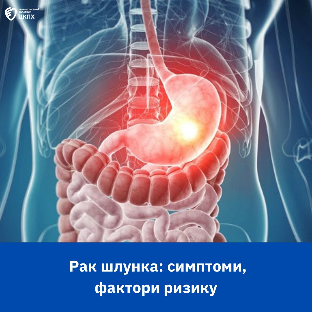 👩🏼‍⚕️Рак шлунка: симптоми, фактори ризику