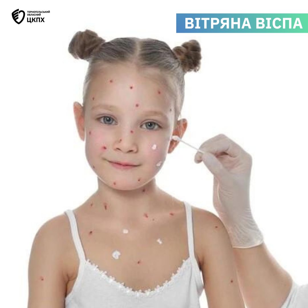 🧑‍⚕️ВІТРЯНА ВІСПА