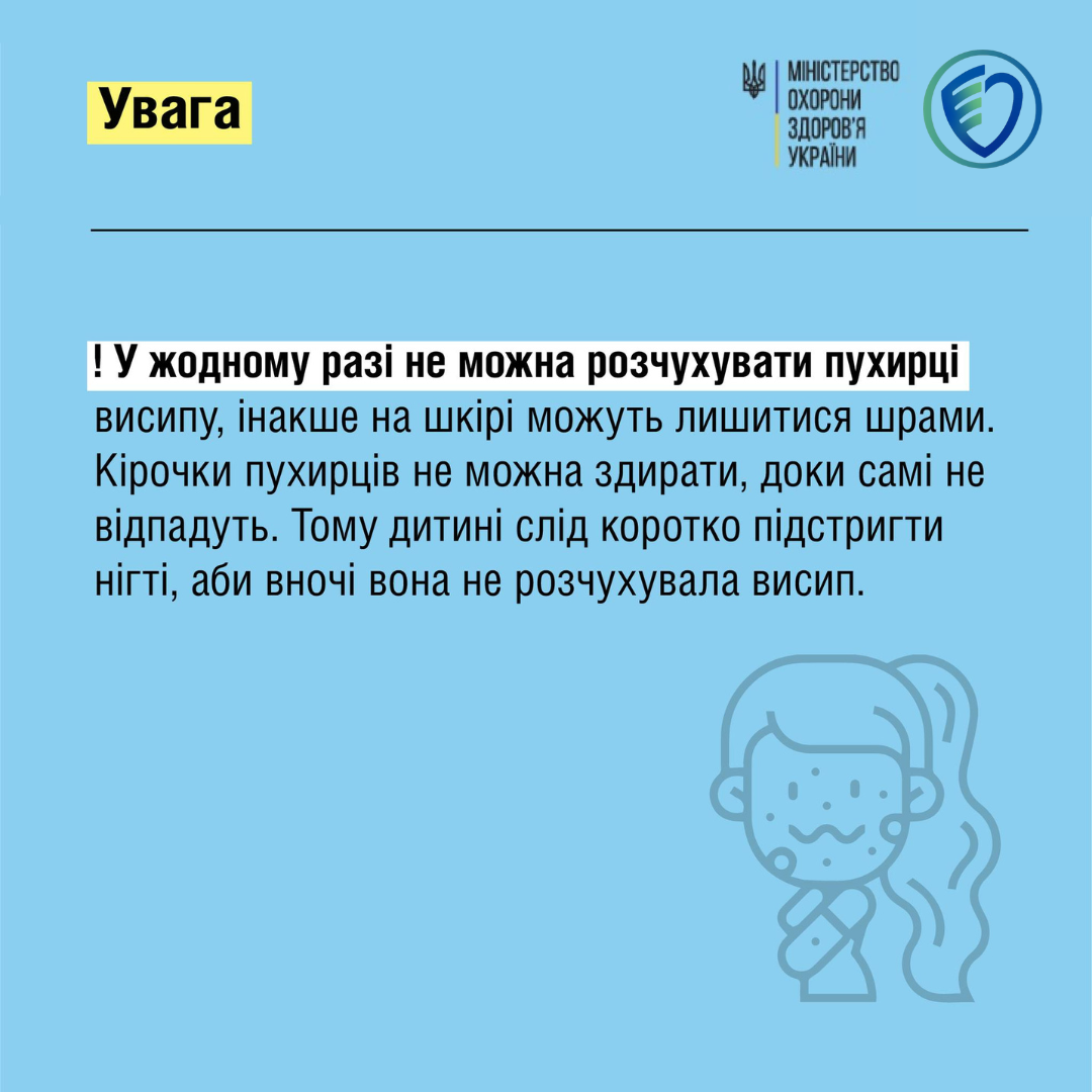 Як полегшити свербіж при вітрянці?